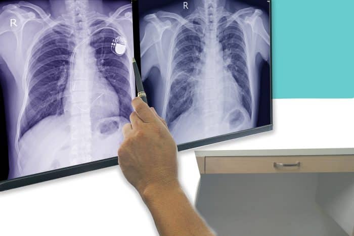 Soft and blurry image chest x-ray film of a patient with cardiac pacemaker, also with congestive heart and cardiomegaly.By surgery. And the doctor's hands are checking the size.